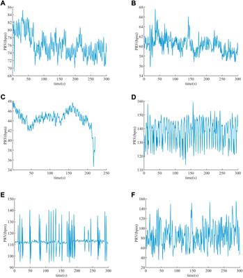 A life-threatening arrhythmia detection method based on pulse rate variability analysis and decision tree